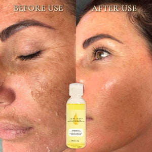 Oilex ™ natural spots brighten yellow peeling oil（Limited time discount 🔥 last day）