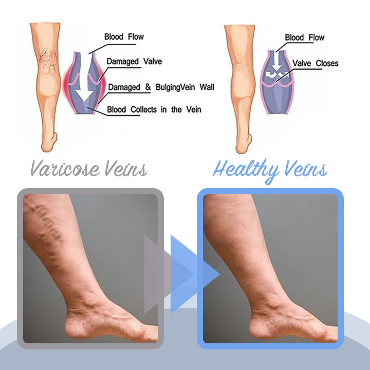 Varicose Veins Spray（Limited time discount 🔥 last day）