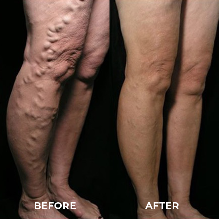 Varicose Veins Spray（Limited time discount 🔥 last day）